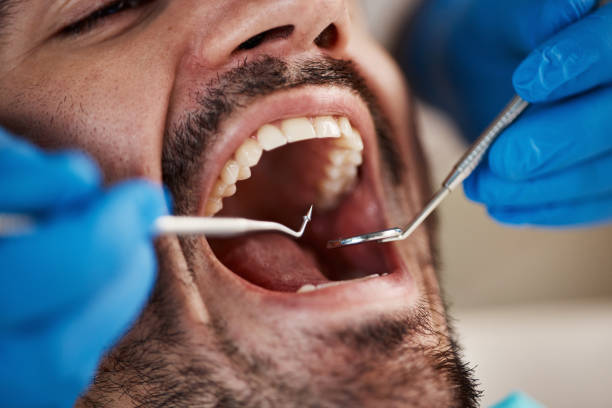 Best Dental Abscess Treatment in Morganton, NC